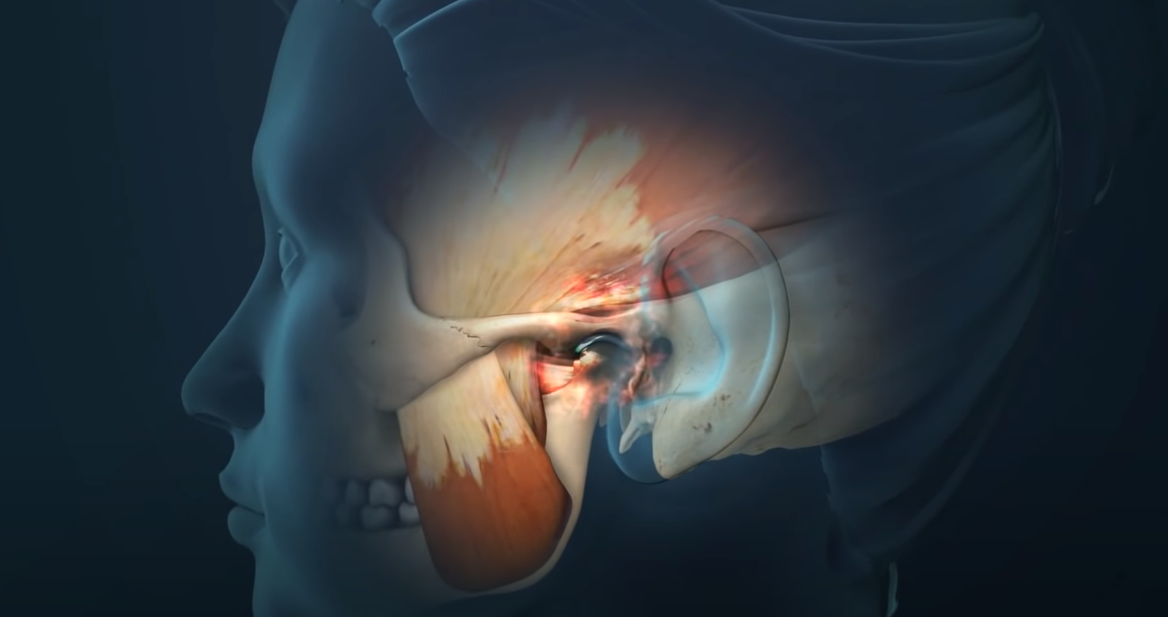 Causes of TMJ