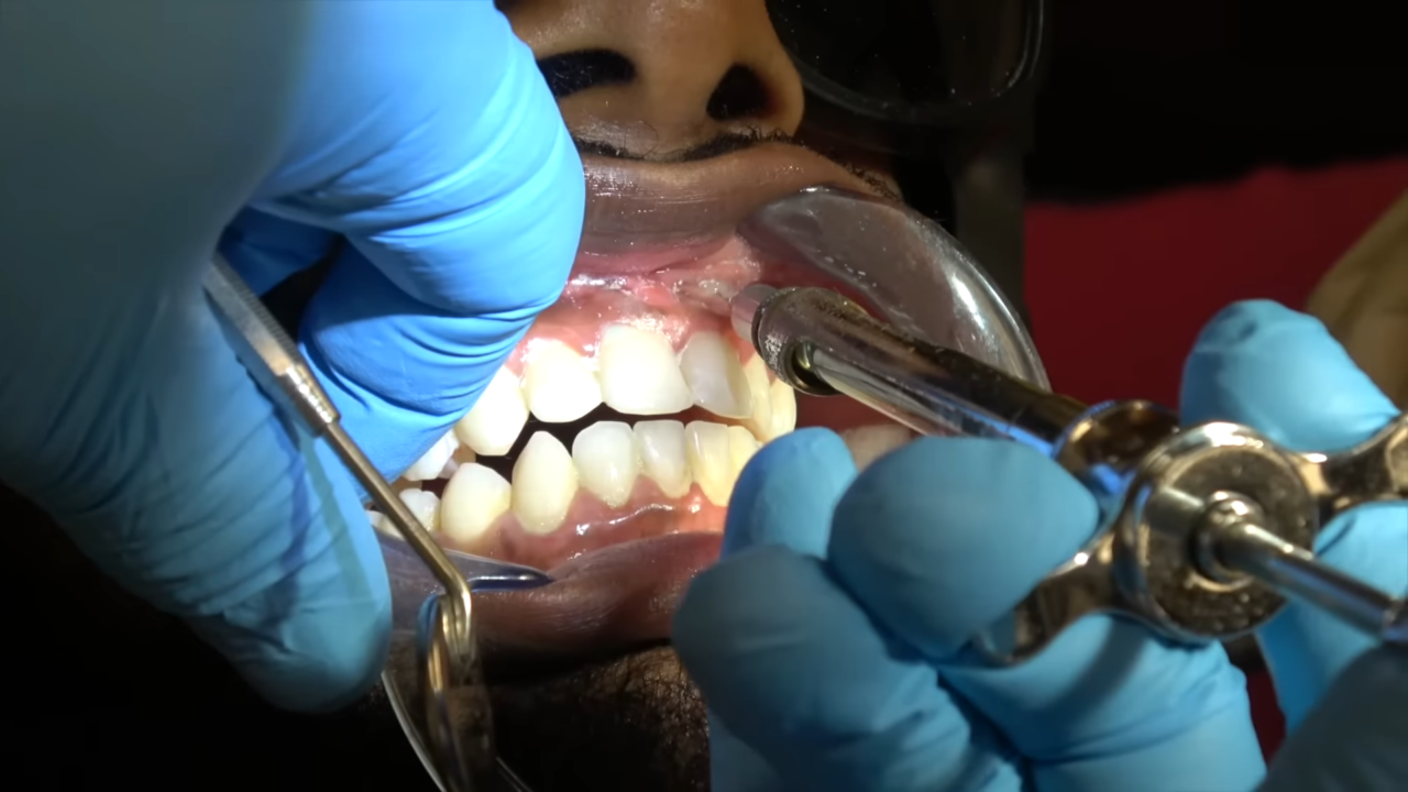 Scaling and Root Planing Hernandez Dental & Implant Center