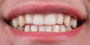 Dental Cleaning