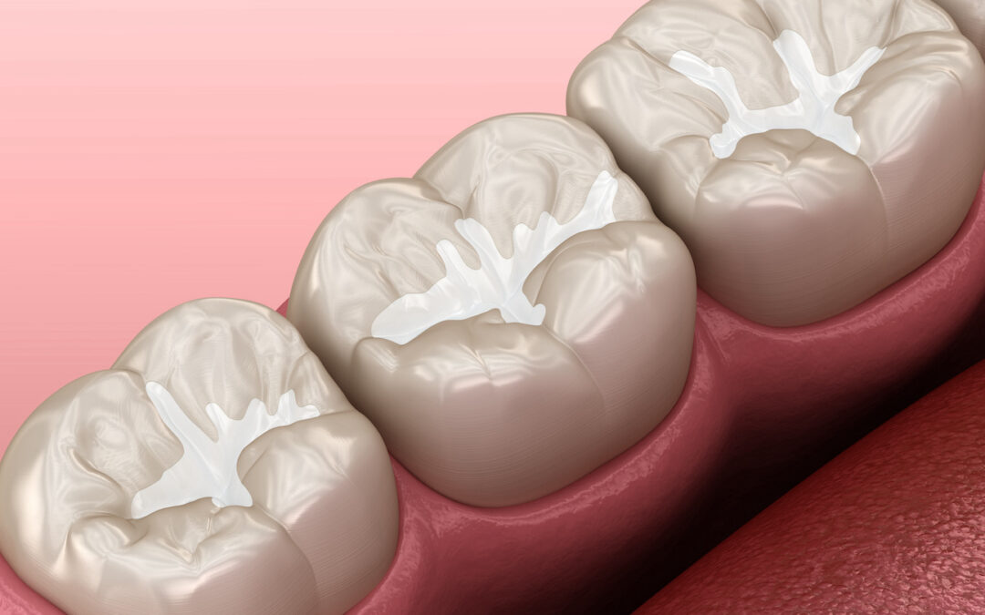 Temporary Filling for Broken Tooth at San Antonio