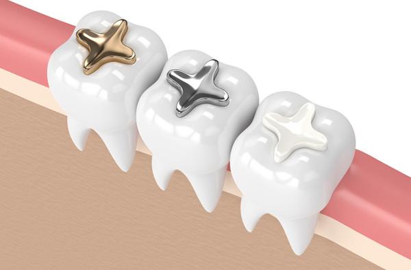 IMG-dental-fillings-GettyImages-925328752
