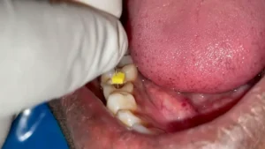 Root canal