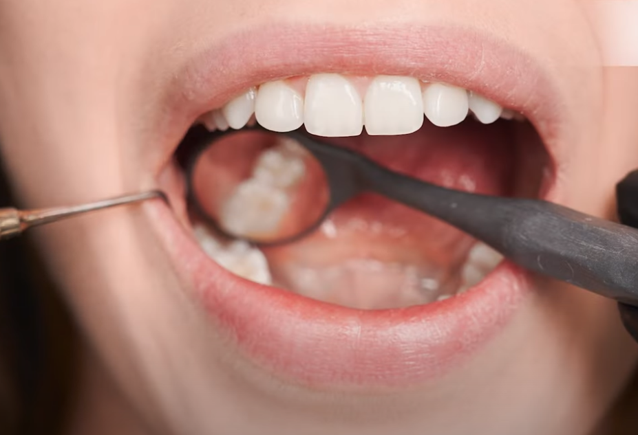 What are tooth-colored fillings