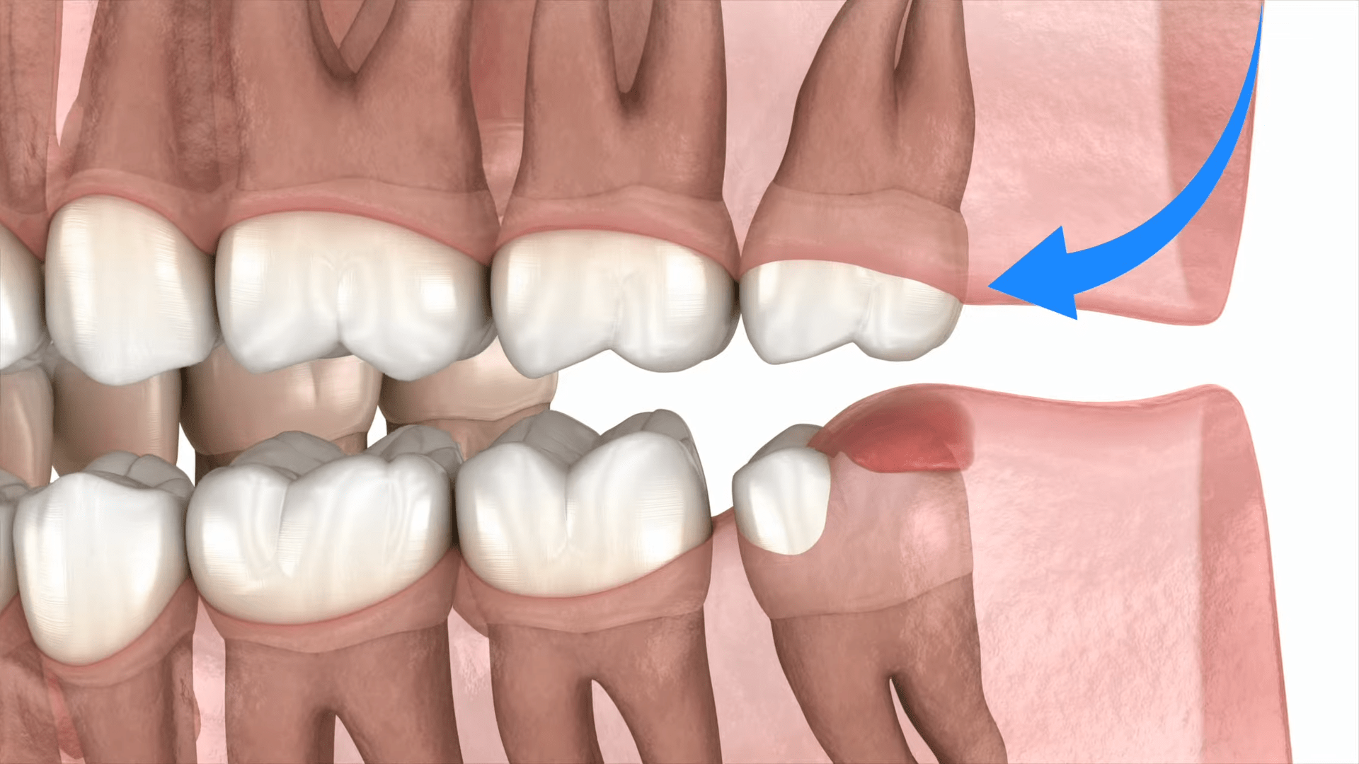 Why Remove Your Wisdom Teeth______-min