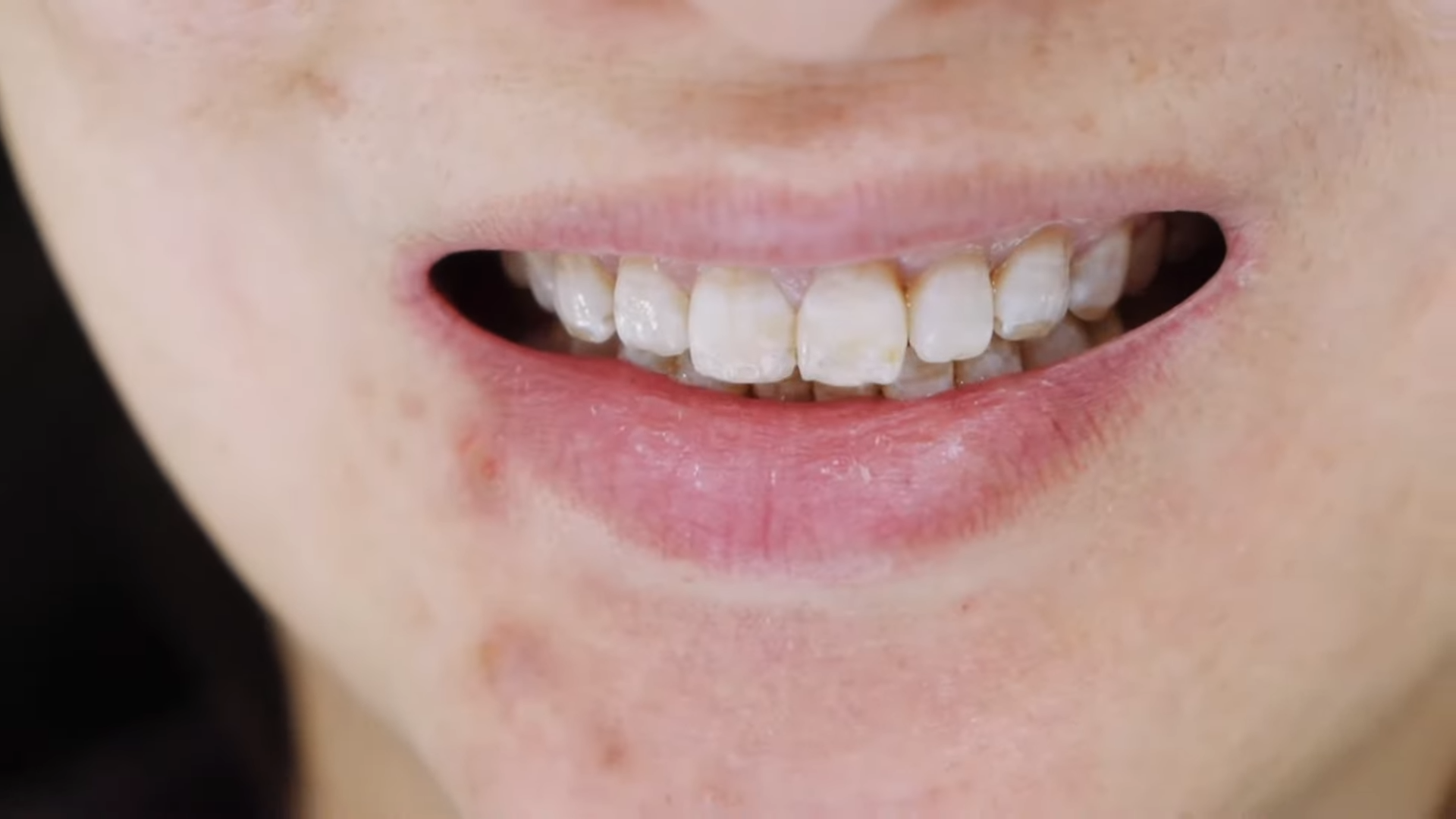affordable full mouth reconstruction