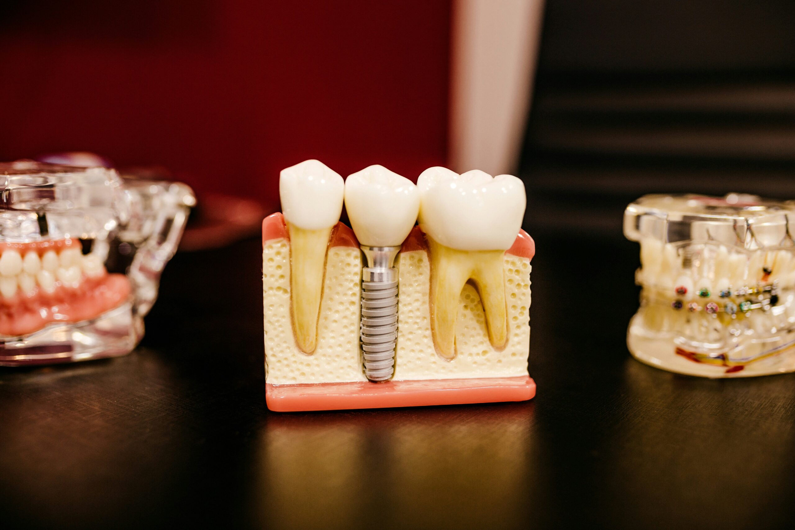 can adults get dental sealants