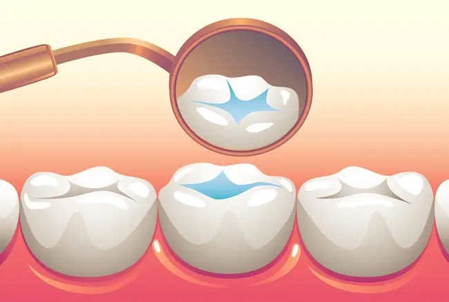 dental-sealant-2