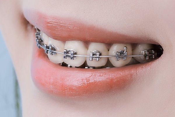 original_braces