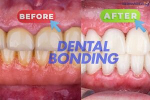 Dental Bonding: Before and After