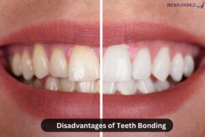 Disadvantages of Teeth Bonding