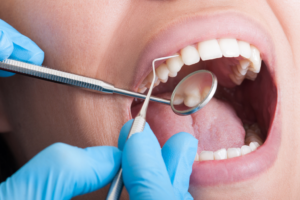 Teeth bonding procedure