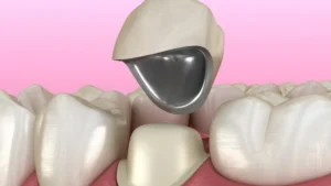 Why do I need a Dental Crown
