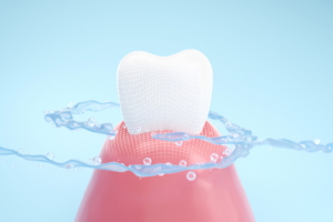 Disadvantages of teeth bonding