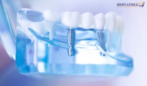 Dental Bridge vs Implant