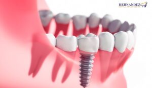Dental Bridge vs Implant