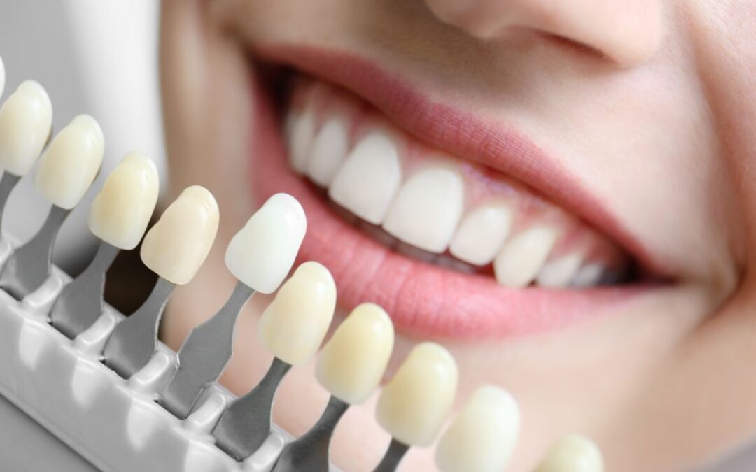 Cosmetic Dental Cost in South San Antonio TX || Hernandez Dental