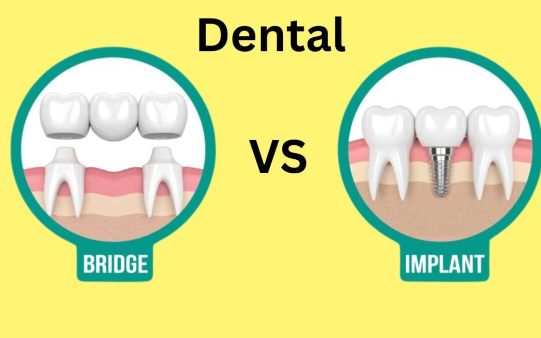 Dental Bridge vs Implant: What’s Best for You