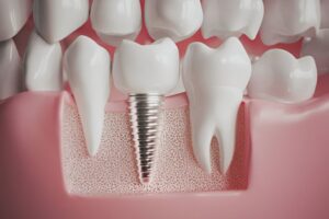 Dental Implant