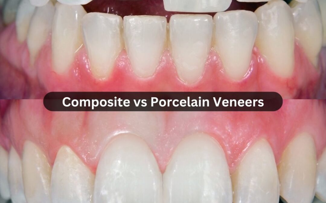 Composite vs Porcelain Veneers: A Comprehensive Guide to Choosing the Best Option
