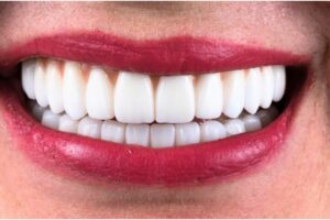 Advantages of Composite Veneers