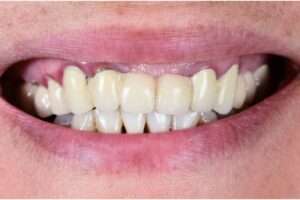 What Are Veneers?