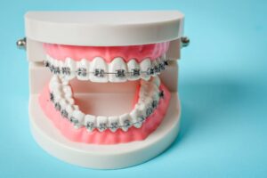 Dental Bonding