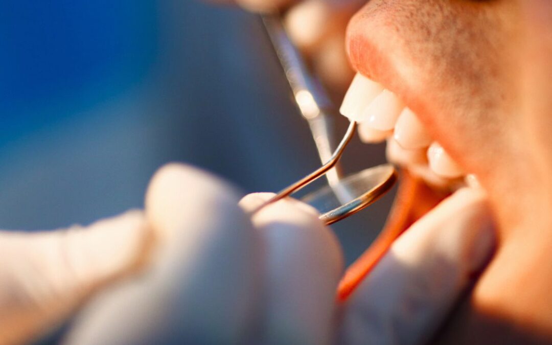 Dental Bonding