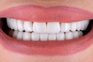 Porcelain Veneers