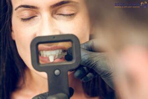 Caring for Veneers