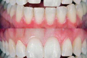 Damaged Veneers