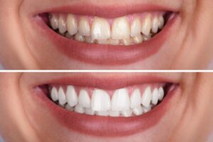 Dental Bonding or Veneers