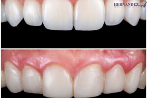 Dental Bonding or Veneers