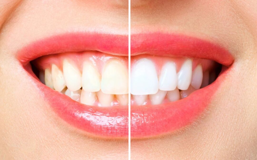 Dental Bonding or Veneers: How to Make the Right Choice 