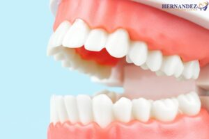 Dental Bonding or Veneers