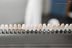 Porcelain Veneers