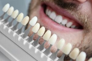 Porcelain Veneers