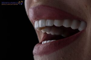 Veneers for Crooked Teeth