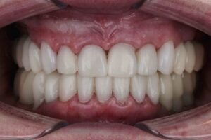 What is dental composite bonding?​