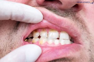 Cracked or broken tooth treatments San Antonio