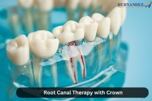 Root Canal Therapy with Crown