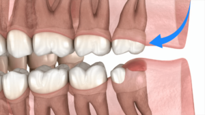 Benefits of Keeping Wisdom Teeth