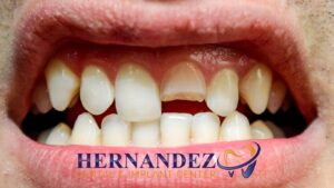 single tooth bridge