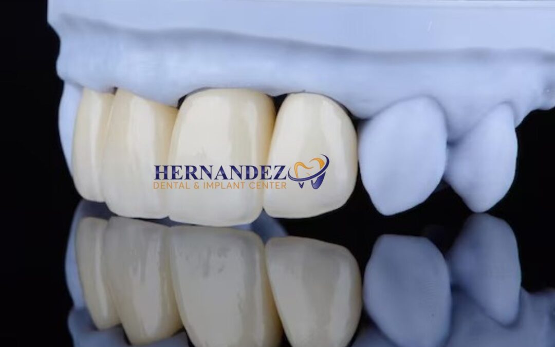Zirconia Crown