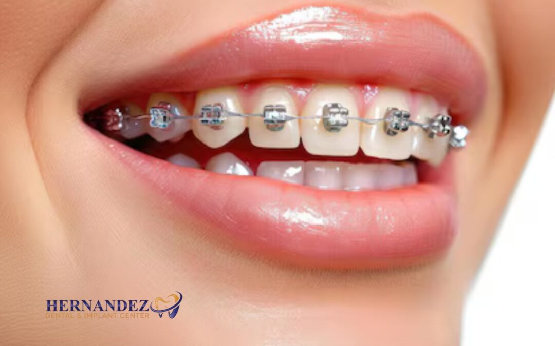 Braces For Adults In San Antonio: What To Know