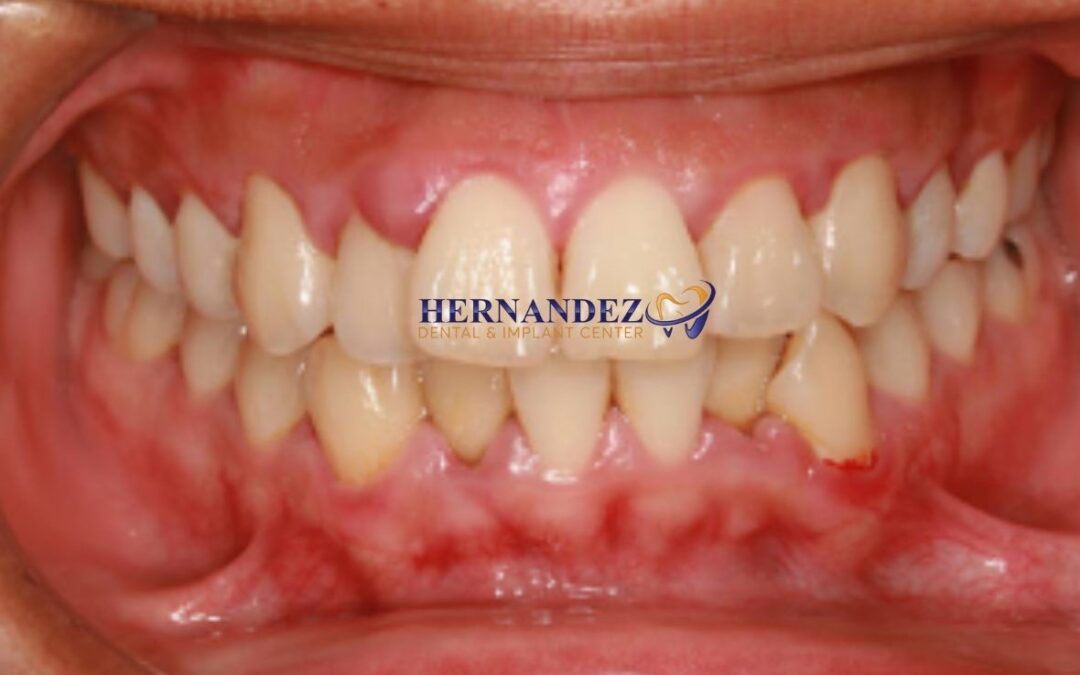 Gums Swollen? What You Need to Know