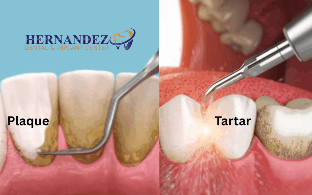 Plaque Vs Tartar: What’s The Difference?