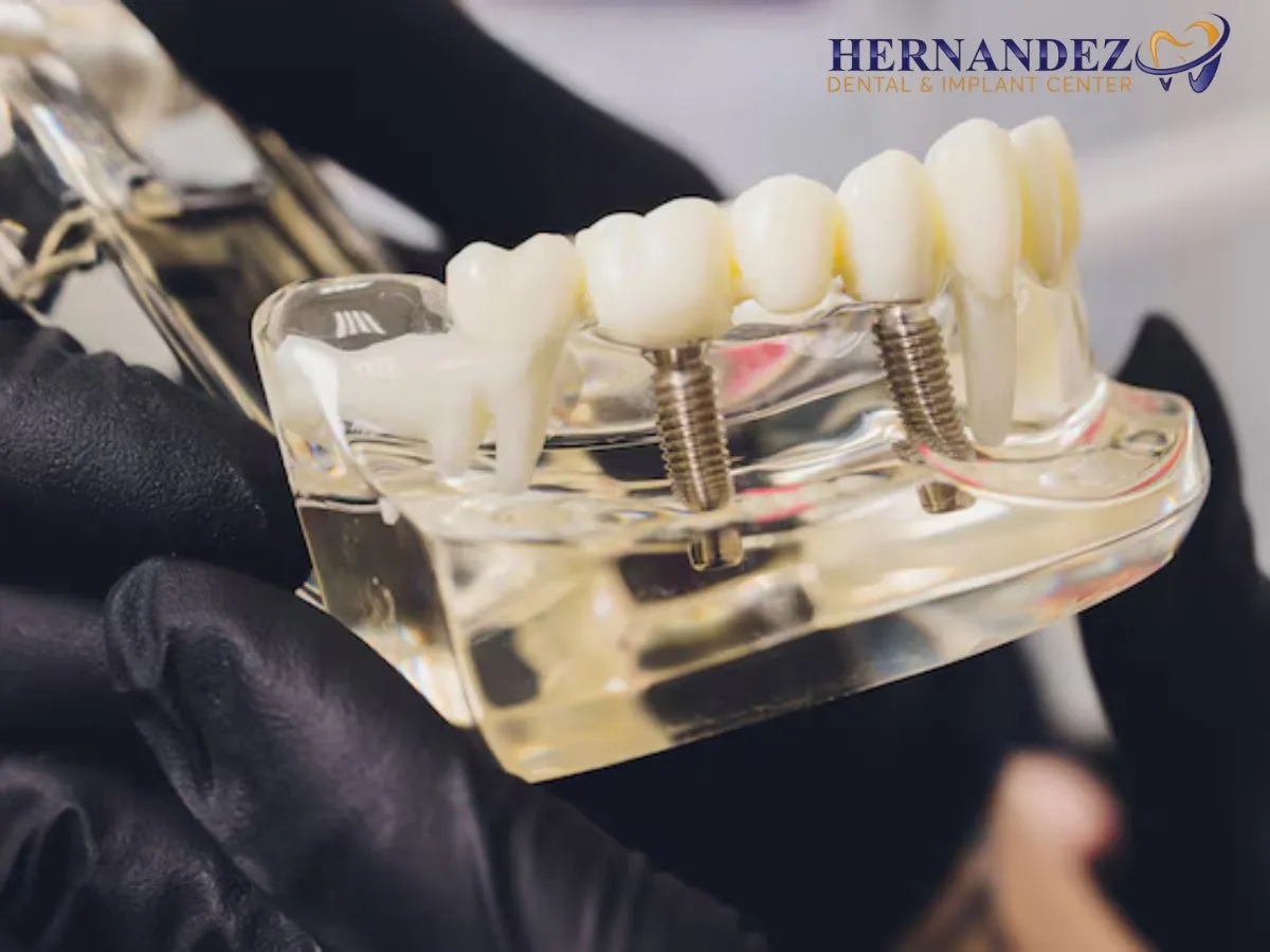 Transparent dental model showing titanium implants anchoring a ceramic bridge into the jawbone.