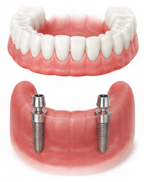 Implant supported dentures