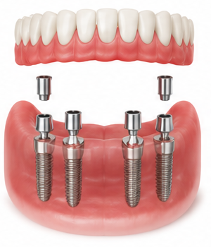 Full mouth dental implants